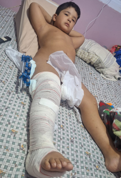 Pós-operatório com fixador externo